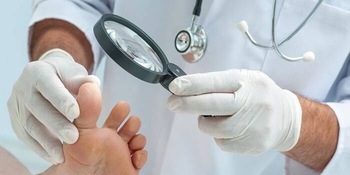 Liječnik s povećalom pregledava stopalo pacijenta sa šiljkom