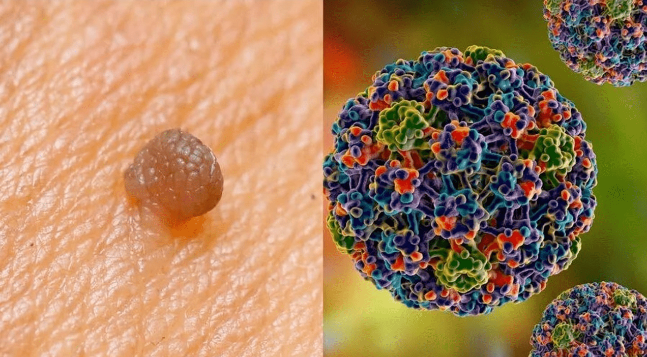 ljudski papiloma virus