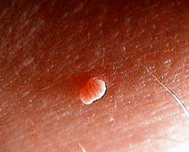 Papiloma na tijelu