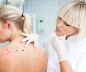 Simptomi virusa ljudskog papiloma