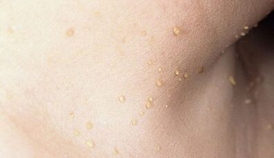 rizik od razvoja papilomatoze na vratu