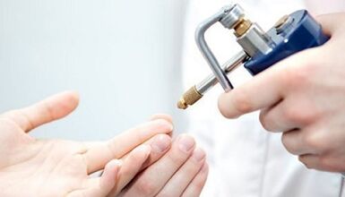 Kriodestrukcija kao metoda liječenja bradavica